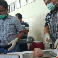 nenek-di-jambi-hamil-selama-37-tahun-bayinya-sudah-membatu