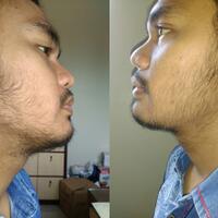 group-brewok-quotbrengozerquot-forum-resmi-berbagi-informasi-progress-hair-facial---part-1