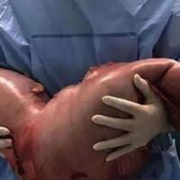 usus-sebesar-ini-sebabkan-pria-ini-mengeluh-sakit-perut-luar-biasa