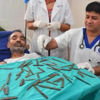 5-hal-mengerikan-yang-pernah-diangkat-dokter-dari-tubuh-manusia