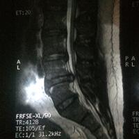 mengenal-syaraf-kejepit---hnp--hernia-nucleus-pulposus