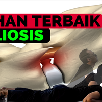 latihan-terbaik-untuk-para-penderita-scoliosis