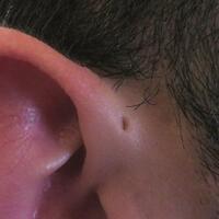 mengapa-sebagian-orang-punya-lubang-kecil-di-telinga-sinus-preauricular