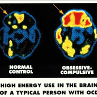 penyakit-ocd-adalah-penyakit-gila-dan-tolol-yang-pernah-ane-lihat