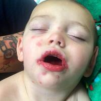 baby-left-fighting-for-life-after-catching-herpes-from-family-friend
