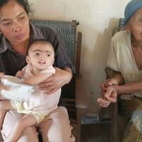 mengidap-penyakit-langka-balita-ini-juga-menderita-kebocoran-jantung-dan-hernia