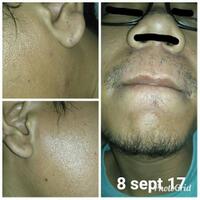group-brewok-quotbrengozerquot-forum-resmi-berbagi-informasi-progress-hair-facial---part-1