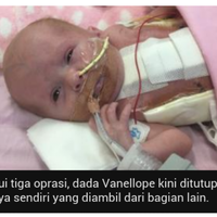bayi-lahir-dengan-jantung-di-luar-tubuh-dokter-sukses-memasukkannya-lewat-operasi