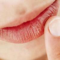 cegah-bibir-pecah-pecah-dengan-cara-ini