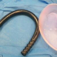 horor-dokter-keluarkan-seks-toy-3-4-meter-dari-anus-pria-inggris