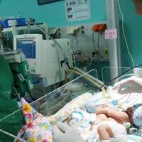bayi-kembar-siam-lahir-di-rsud-soetomo-kondisinya-belum-stabil