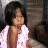 bocah-13-tahun-idap-gizi-buruk-di-tangerang