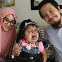 perjuangan-annabella-yang-tak-sanggup-menelan-makanan-hingga-lupa-bernapas-saat-tidur