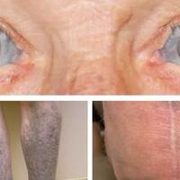 minum-antibiotik-untuk-peradangan-mata-pria-ini-malah-berubah-menjadi-biru