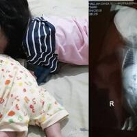 perjuangan-athallah-bayi-yang-lahir-tanpa-tangan-kanan-dan-hanya-punya-tiga-jari