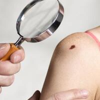waspada-perubahan-pada-tahi-lalat-bisa-jadi-kanker