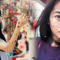 dulu-sering-dibully-karena-tahi-lalat-kehidupan-gadis-ini-kini-berubah-180-derajat