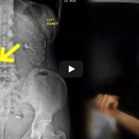 ngeri-karena-badannya-terlalu-kurus-ginjal-wanita-ini-melorot-turun-ke-panggul