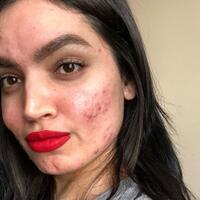 punya-jerawat-yang-mengerikan-wanita-ini-malah-jadi-beauty-selebgram