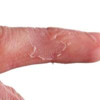 agan-tau-kenapa-kulit-tangan-sering-mengelupas