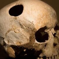 ngeri-ini-5-pengobatan-ekstrem-yang-dilakukan-pada-zaman-dahulu