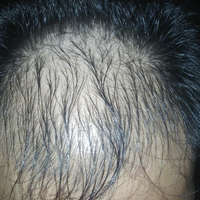 reborn-help-rambut-gua-rontok-hampir-botak