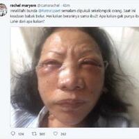 ratna-sarumpaet-dikeroyok-orang-tak-dikenal-prabowo-sandi-akan-jenguk