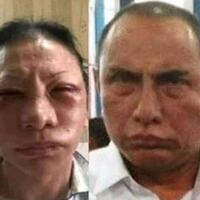 ada-kecurigaan-lebam-ratna-sarumpaet-akibat-operasi-plastik