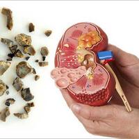 8-cara-mencegah-penyakit-batu-ginjal-yang-bisa-mematikan