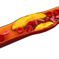 jangan-diabaikan-inilah-5-gejala-kolesterol-tinggi