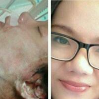 butuh-doa--biaya-seperti-ini-kondisi-mahasiswi-yang-dibakar-mantan-pacarnya