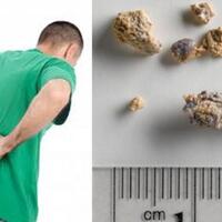 masyarakat-yang-tinggal-di-daerah-ini-lebih-rentan-terkena-batu-ginjal