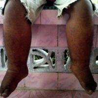 penyakit-kaki-gajah-dapat-ditularkan-melalui-semua-jenis-nyamuk