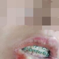 pasang-kawat-gigi-palsu-bibir-wanita-ini-bengkak-dan-bernanah