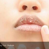 atasi-bibir-kering-dan-pecah-pecah-dengan-5-cara-alami-ini