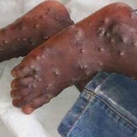 awas-cacar-monyet-berawal-di-singapura-bisa-mampir-ke-indonesia