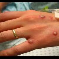 cegah-cacar-monyet-pemeriksaan-orang-datang-dari-singapura-diperketat