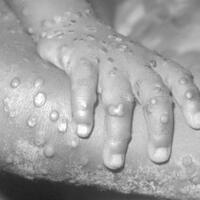 pemerintah-minta-masyarakat-waspada-cacar-monyet