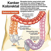 mengungkap-penyebab-kanker-kolorektal