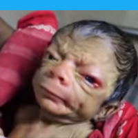bayi-ini-lahir-dengan-wajah-tidak-biasa-haruskan-menjadi-sebuah-beban-kehidupan