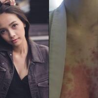 sering-kerja-lembur-di-luar-batas-cewek-ini-alami-hal-mengerikan-di-tubuhnya