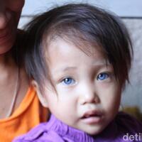unik-anak-balita-di-bandung-miliki-bola-mata-tiga-warna