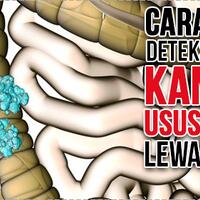 keren-kini-ilmuwan-temukan-cara-baru-analisa-kanker-lewat-warna-urinmu