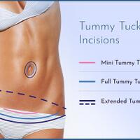 keunggulan-dari-operasi-tummy-tuck