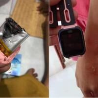 tangan-anak-ini-melepuh-gara-gara-jam-kw-meledak