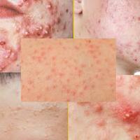 cara-menghilangkan-jerawat