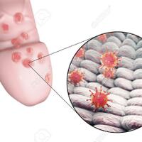 hentikan-herpes-genital-menyebar-dengan-terapi-gelombang-mikro