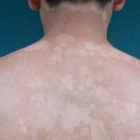 cara-menghilangkan-panu-sampai-ke-akarnya-secara-alami