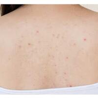 punya-jerawat-punggung--mungkin-ini-salah-satu-penyebabnya