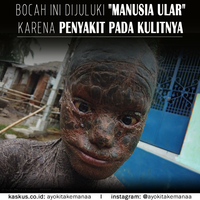 bocah-ini-dijuluki-quotmanusia-ularquot-lantaran-penyakit-yang-menyerang-kulitnya